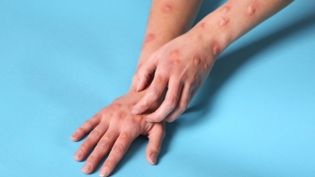 Imagem de Caso de vírus Monkey Pox detetado nos Açores: Governo reforça oferta de vacinas