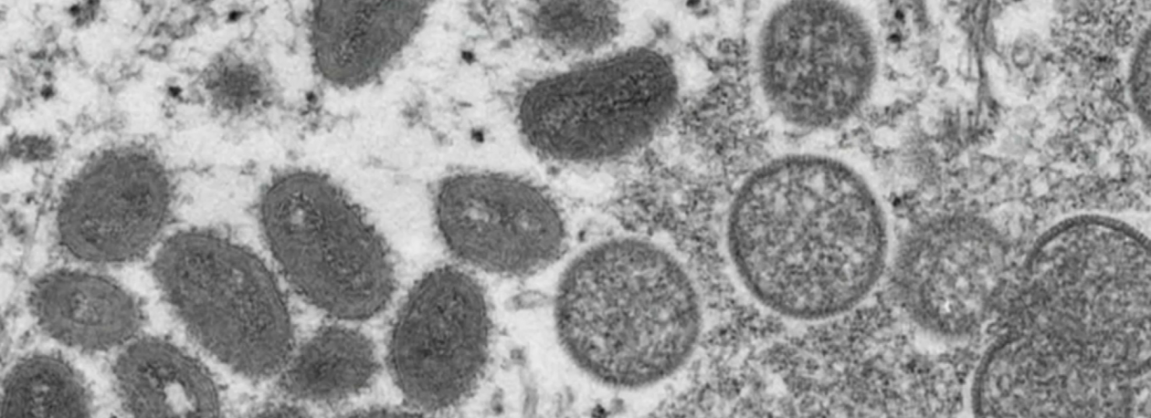 Imagem de Caso de Monkeypox detetado nos Açores em não residente