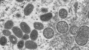 Imagem de Caso de Monkeypox detetado nos Açores em não residente