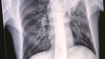 Imagem de Pneumologista Tiago Sá considera urgente avançar com rastreio do cancro do pulmão
