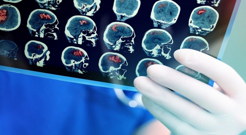 Imagem de Número de doentes internados com AVC está a aumentar nos Açores