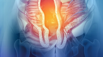 Imagem de Açores avançam com projeto inovador de medicina personalizada para cancro colorretal