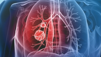 Imagem de Rastreio cancro do pulmão: Mónica Seidi diz que programa deverá avançar até primeiro trimestre de 2026