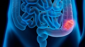 Imagem de Cancro colorretal: Projeto pioneiro de medicina personalizada lançado hoje