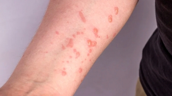 Imagem de Vírus MPOX sem novos casos nos Açores desde junho