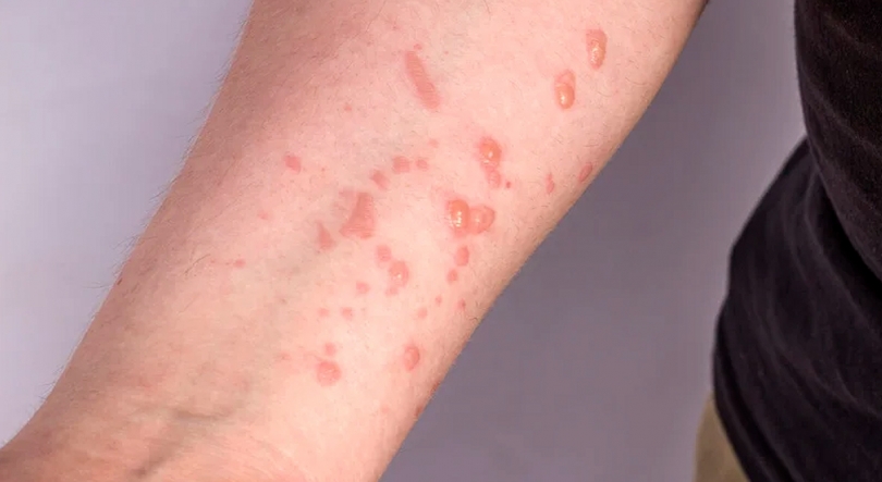 Imagem de Vírus Mpox sem novos casos nos Açores desde junho