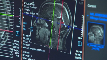 Imagem de Alzheimer: Diretoras clínicas do HDES E HSEIT defendem que rastreio em massa não é o correto