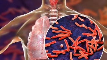 Imagem de Açores com taxa mais baixa de casos de tuberculose a nível nacional
