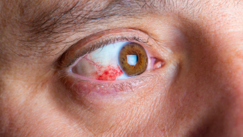 Rastreios à retinopatia diabética identificam doença ocular na população açoriana