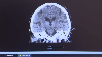 Alzheimer: Novo teste ao sangue permite diagnóstico simples e rápido